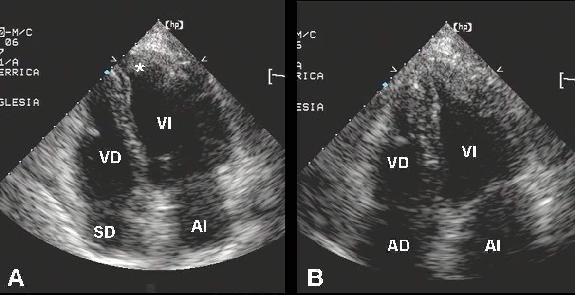 Ecocardiografia bidimensionala